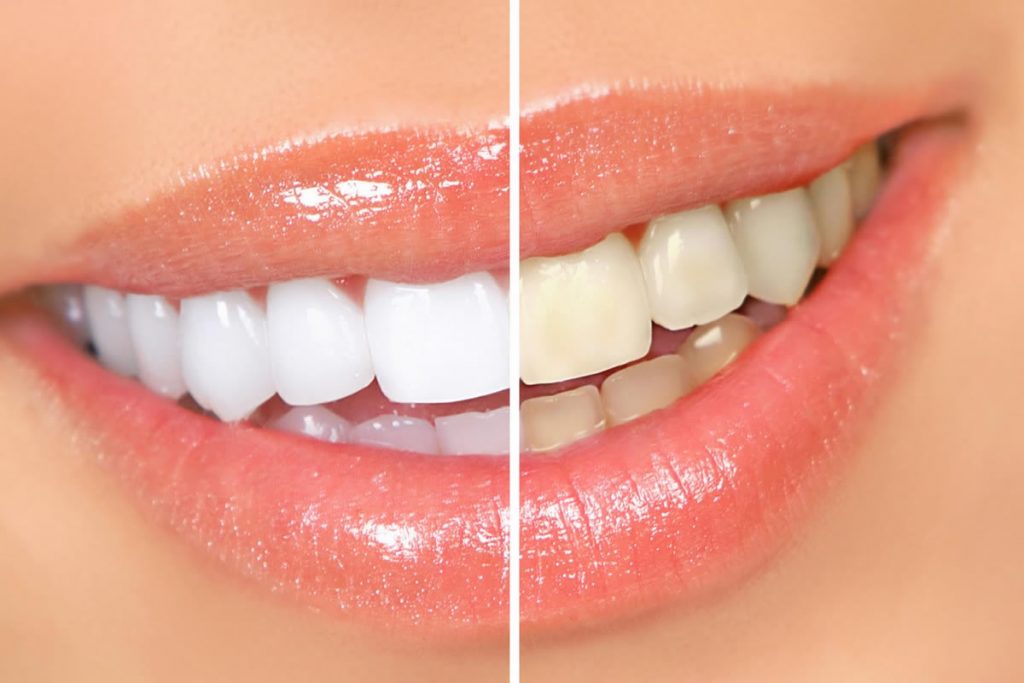 Tipos de Clareamento Dental