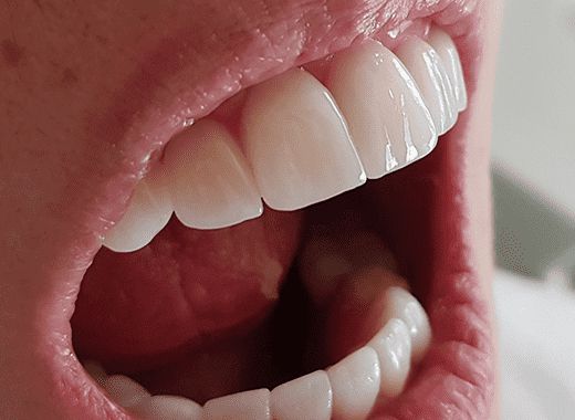 Textura das Lentes de Contato Dental