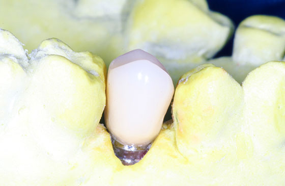 Molde de Implante Dentario colocado na boca.