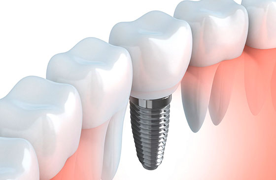 Implante Dentario Interno