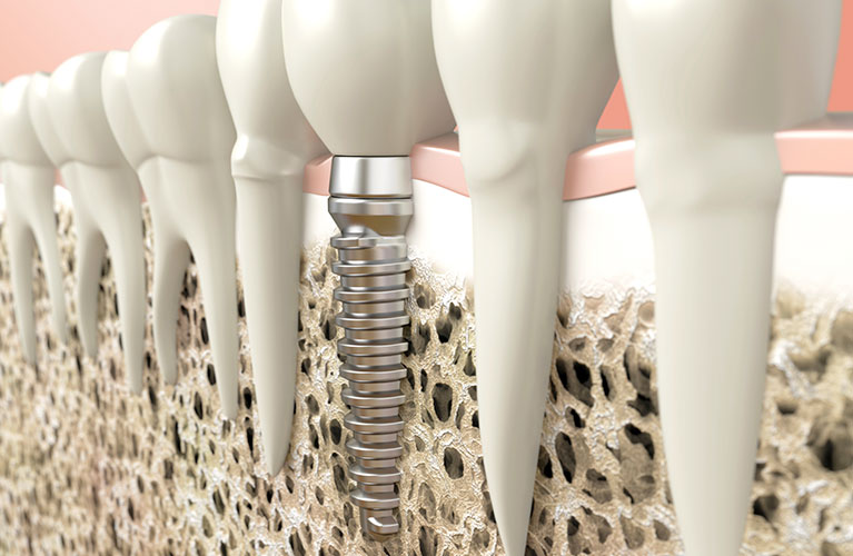 Implante Dentario tudo que você precisa