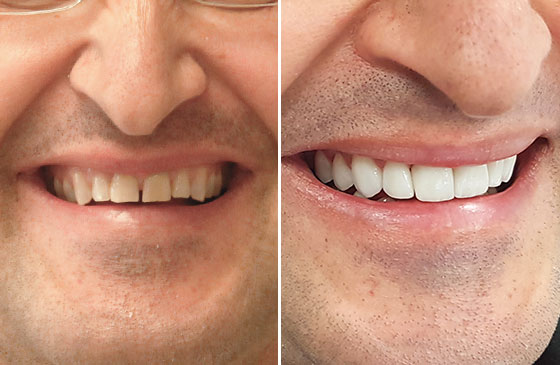 Lente de Contato Dental em 48 Horas Antes e Depois