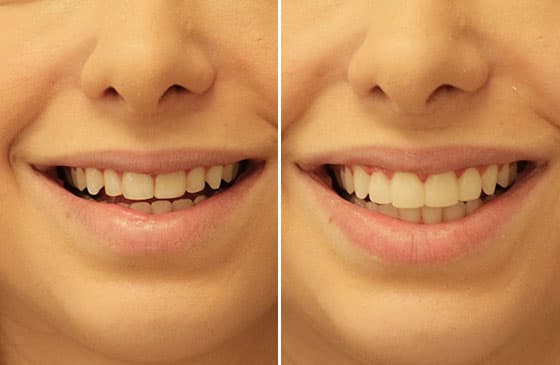 planejamento do sorriso antes e depois