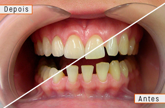 lente de contato para os dentes antes e depois